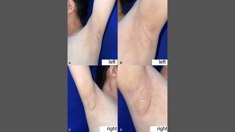 filipinli kadinin koltukaltindan sut geldi nadir gorulen durumun nedeni ne rOjqRWcq.jpg